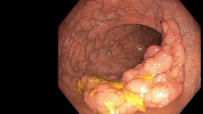 Endoscopic mucosal resection 1
