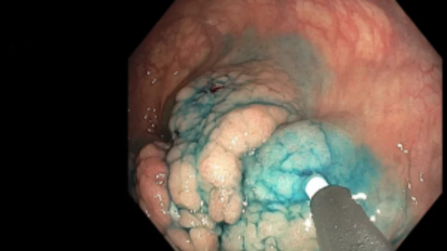 Endoscopic mucosal resection 2