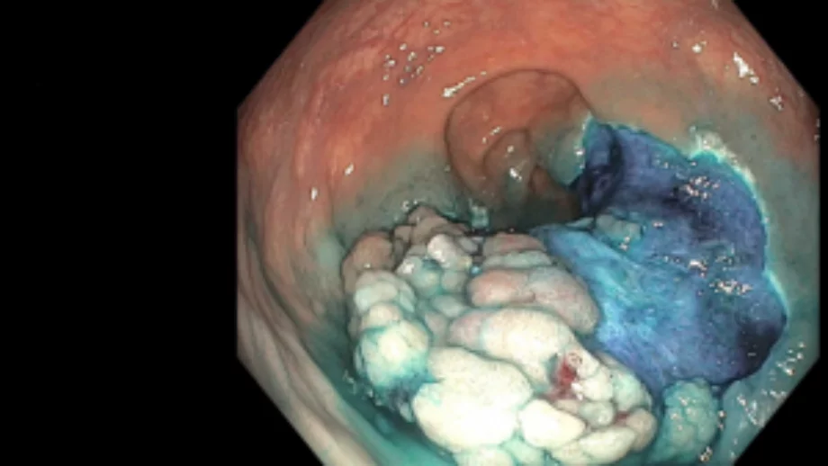 Endoscopic mucosal resection 3