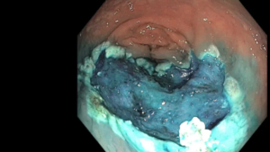 Endoscopic mucosal resection 4